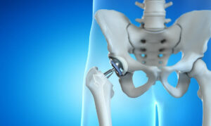 biaya operasi hip replacemen